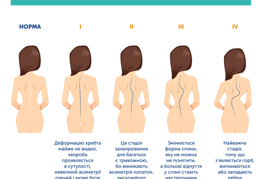 ЧИМ НЕБЕЗПЕЧНИЙ СКОЛІОЗ?