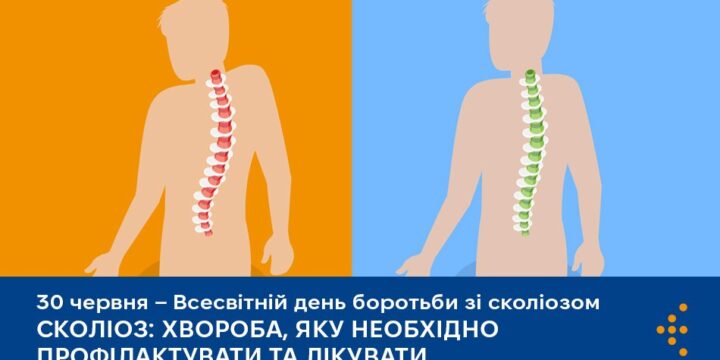 Сколіоз: хвороба, яку необхідно профілактувати та лікувати